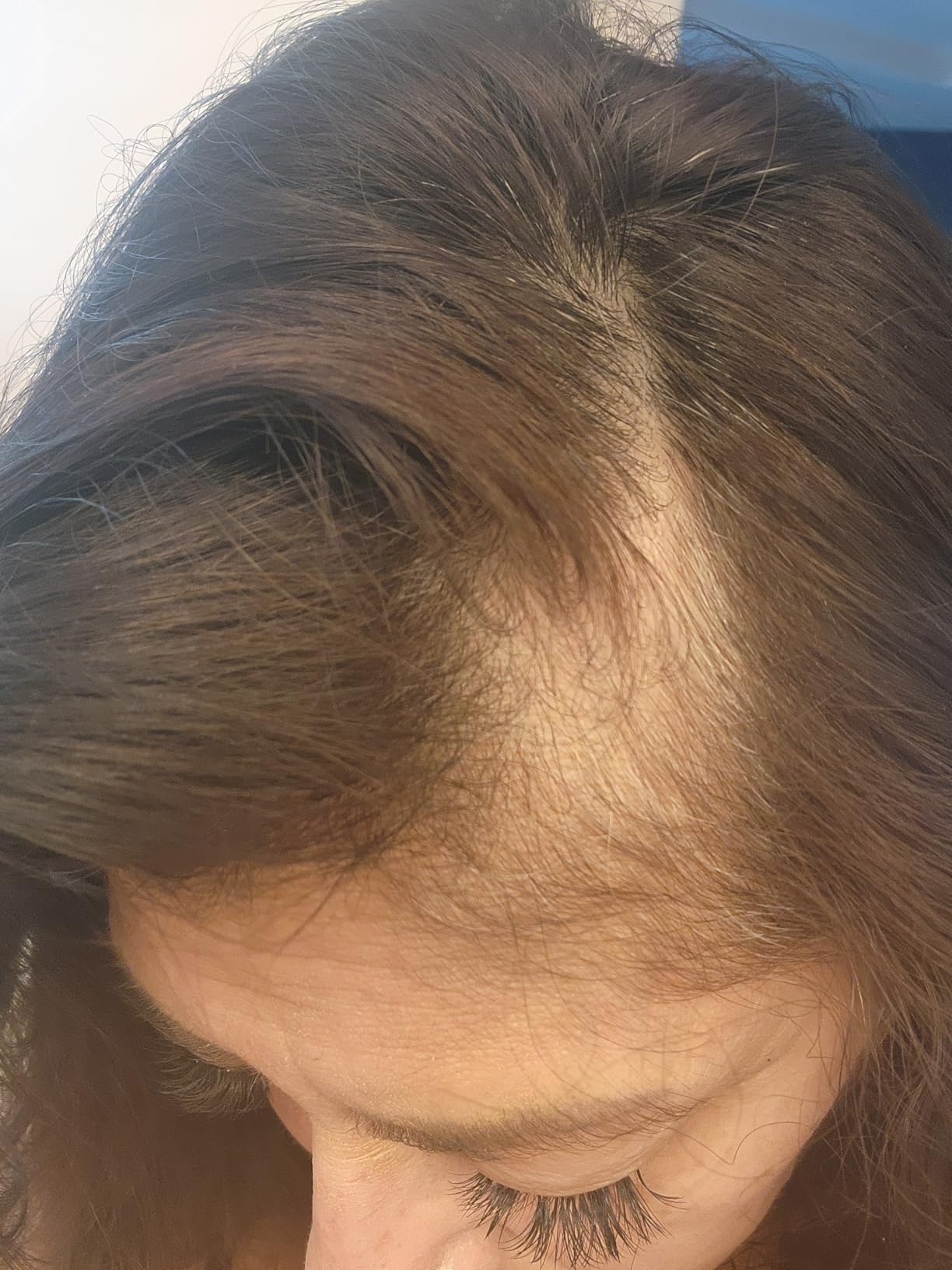 Avant — cuir chevelu clairsemé