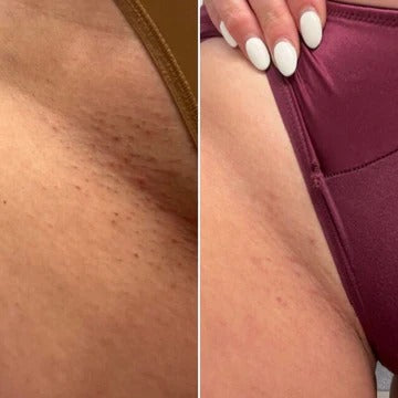 Before and after hair removal comparison