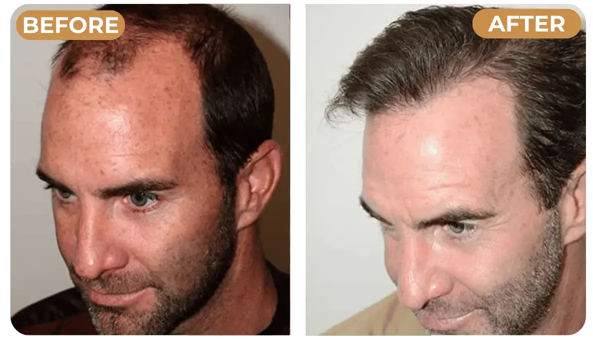 Avant / Après - densité capillaire