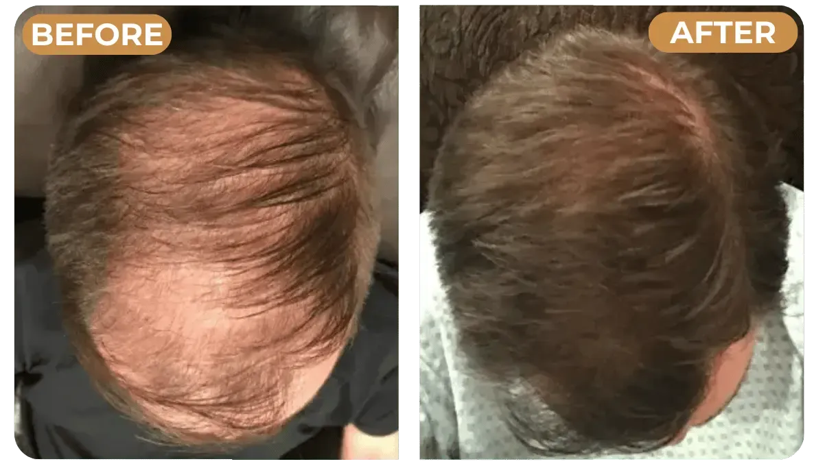 Avant / Après - repousse